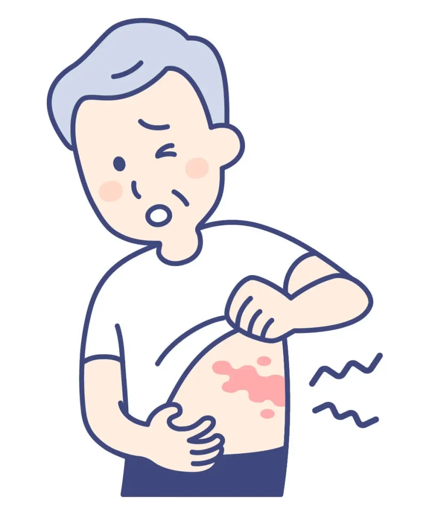 【帯状疱疹(たいじょうほうしん)】発症原因や症状、治療方法とは？漢方を用いるメリットや効果を詳しく解説